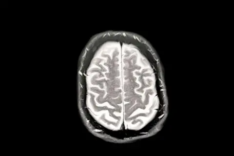 Getty Images A scan of a brain showing early Dementia/Alzheimer's
